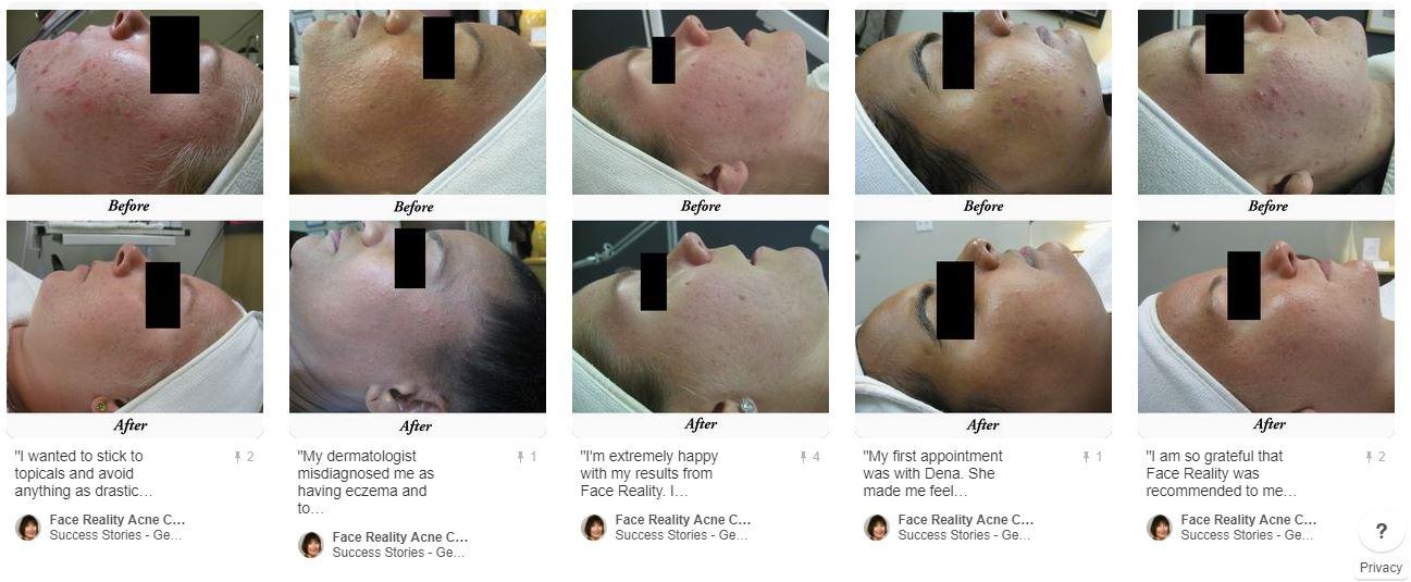 Acne clinic results