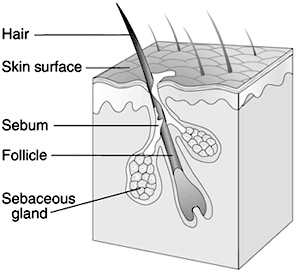 Acne during pregnancy