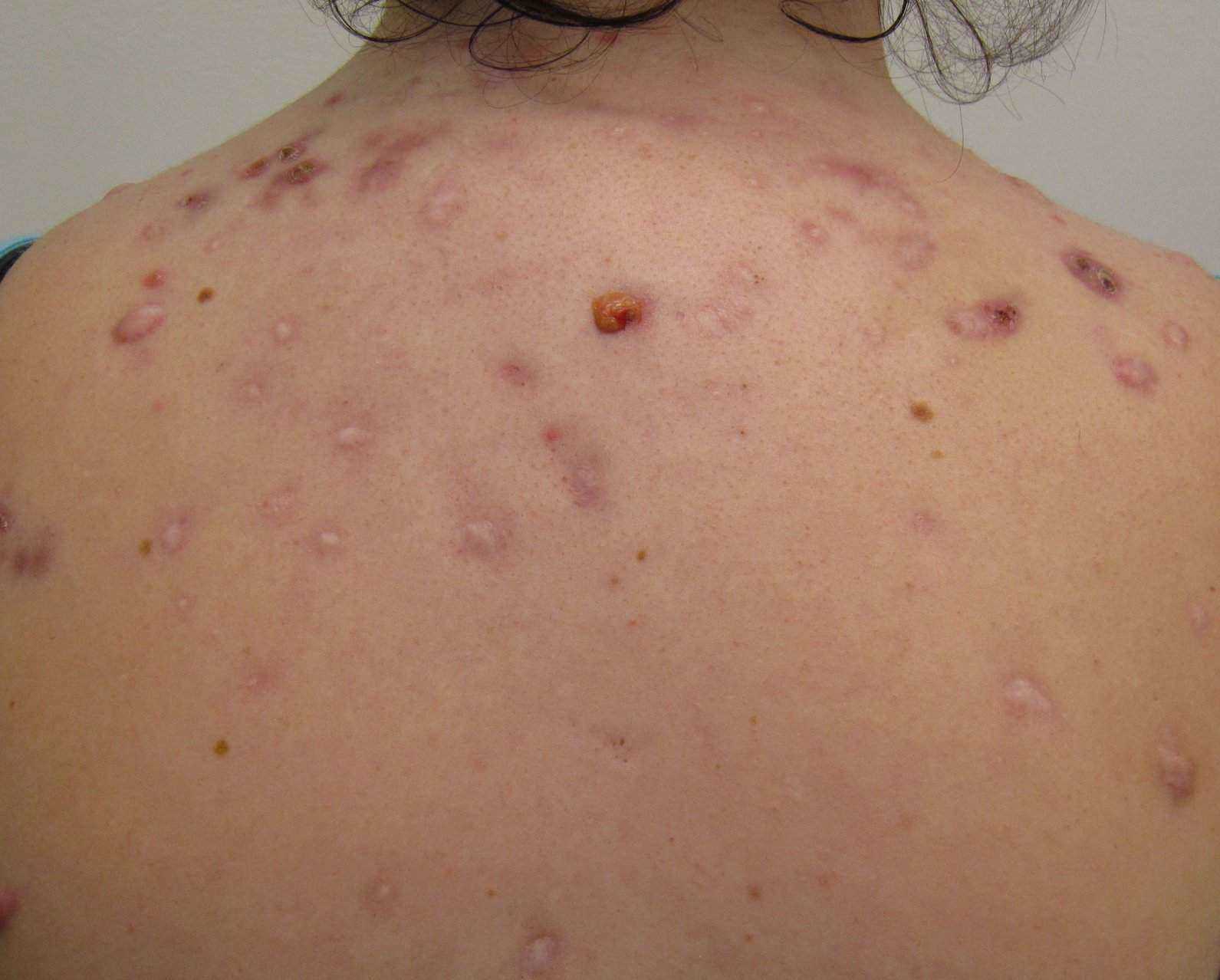 Body acne during pregnancy