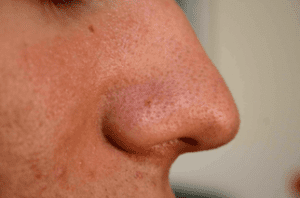 Blackheads - type of acne