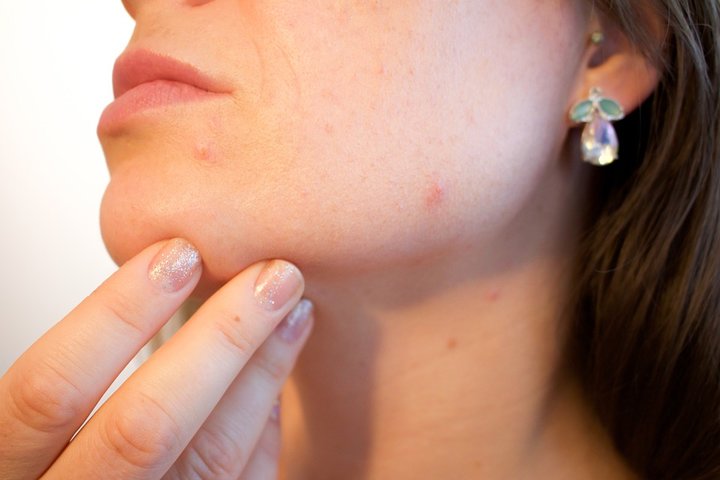 Pregnancy acne and treating spots