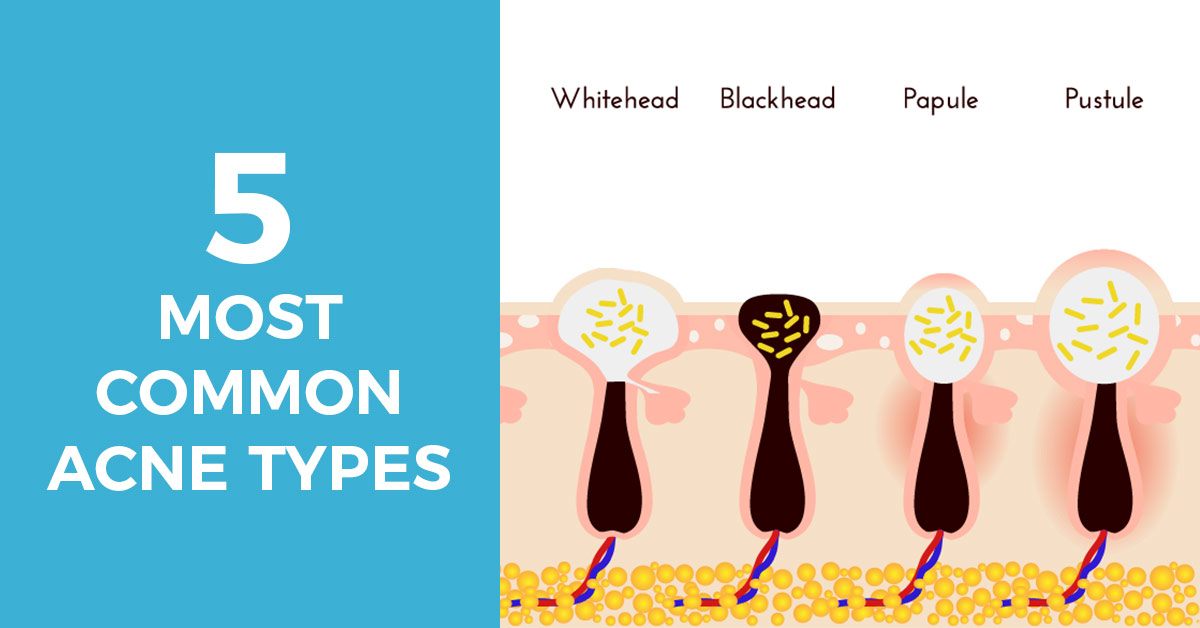 most common acne types