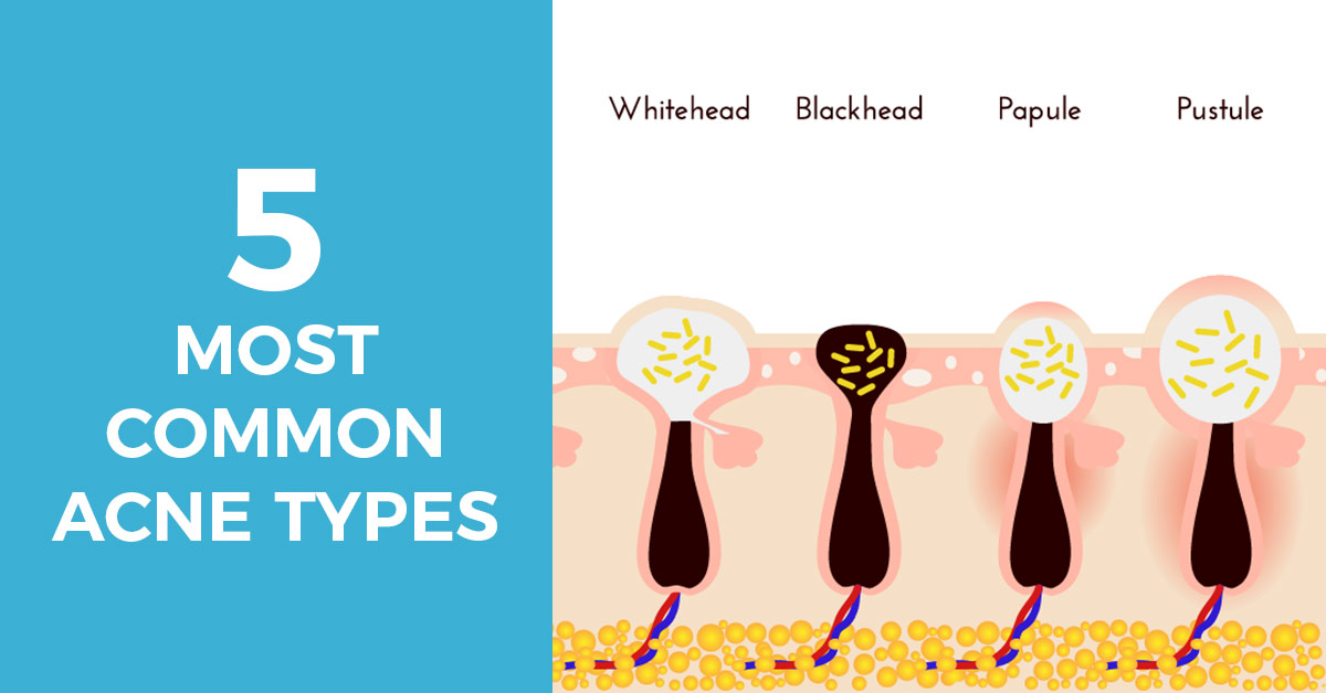 The 5 Most Common Types of Acne