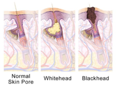 Non Inflammatory acne type