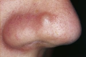 One of the most common types of acne - papules