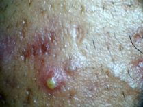 Pustules - type of acne