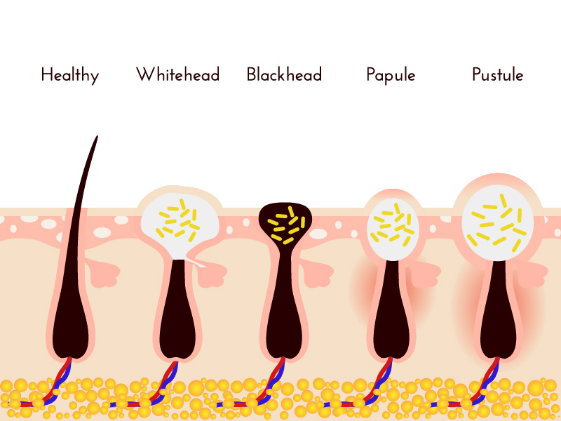 Types of body acne