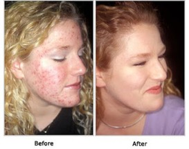 Acnefree before-after