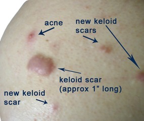 Keloid Acne Scar