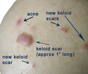 Keloid Acne Scar