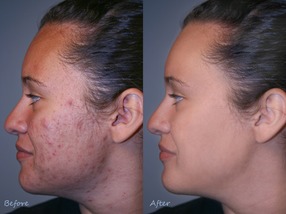 Adult acne before and after