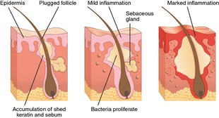 What causes adult acne?