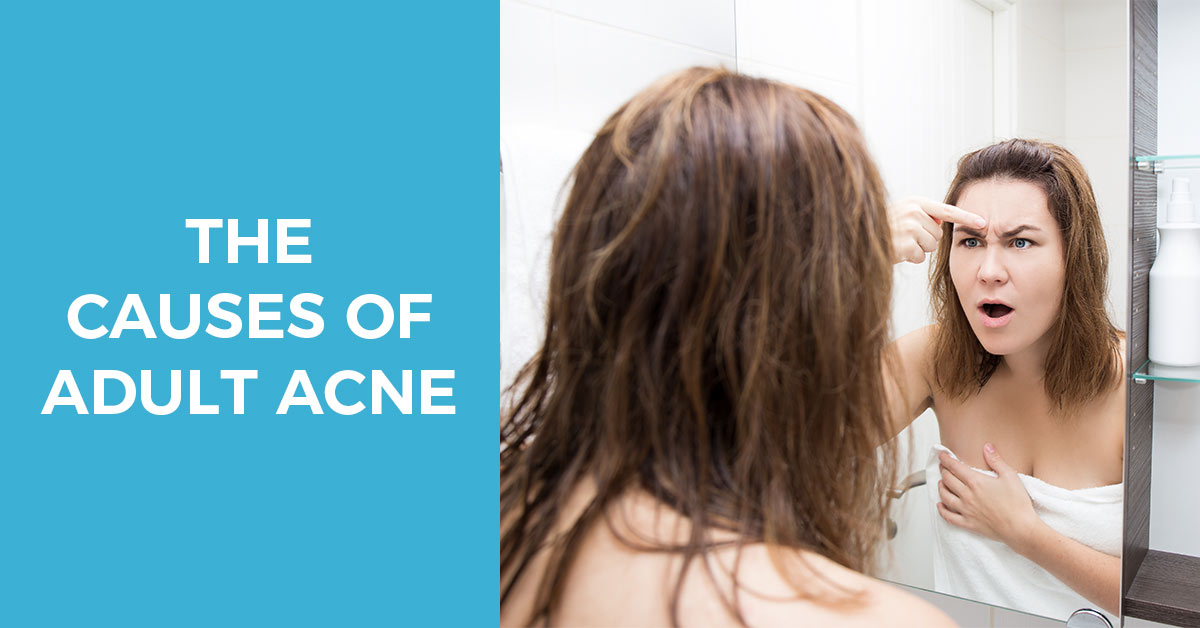 causes of adult acne