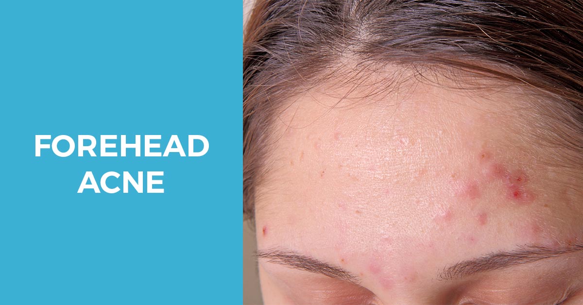How to get rid of forehead acne?