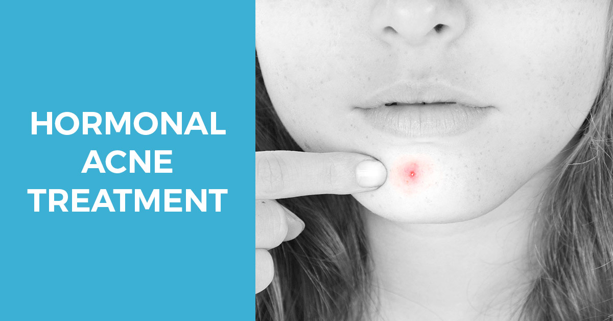 hormonal acne treatment