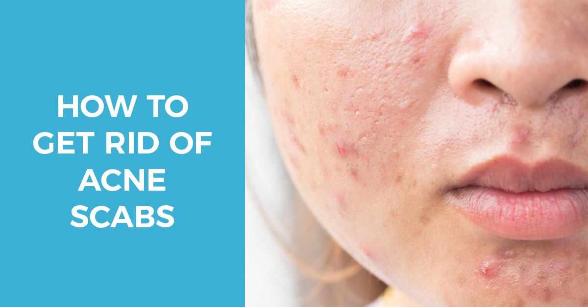 acne scabs and how to get rid of them for good