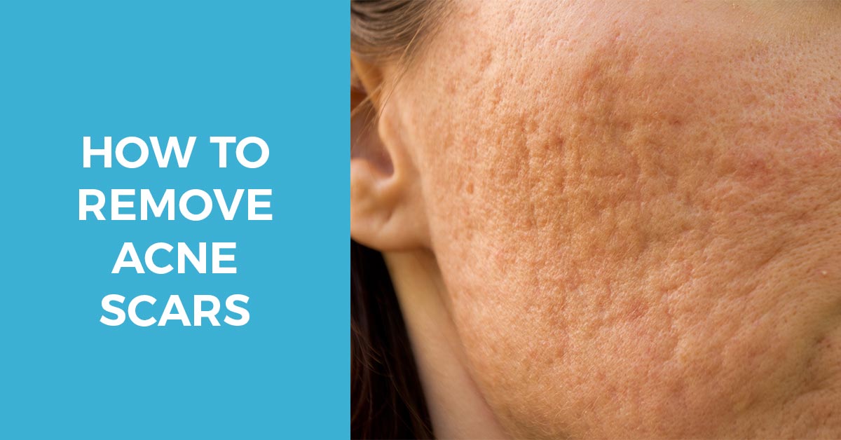 How to remove acne scars