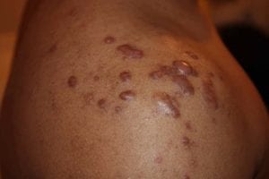 Keloid shoulder acne scars