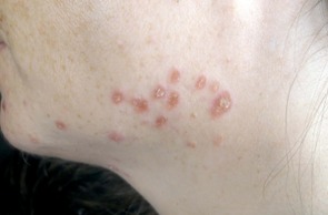 Adult acne medication helps for papules