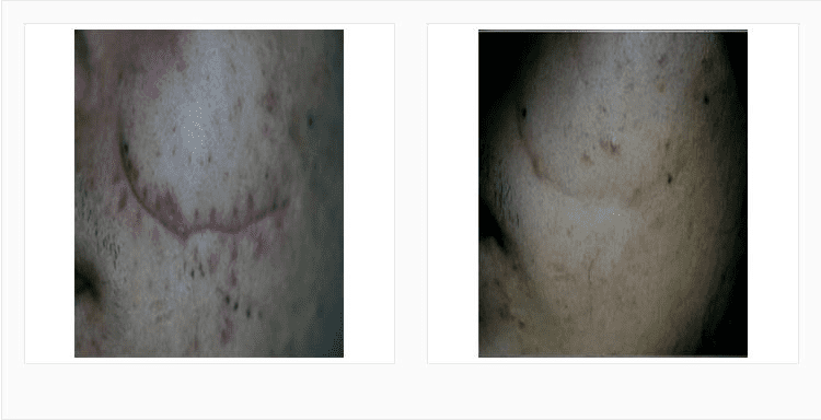 Laser Acne Scar Removal