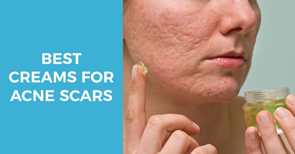 What Are the Best Creams for Acne Scars?