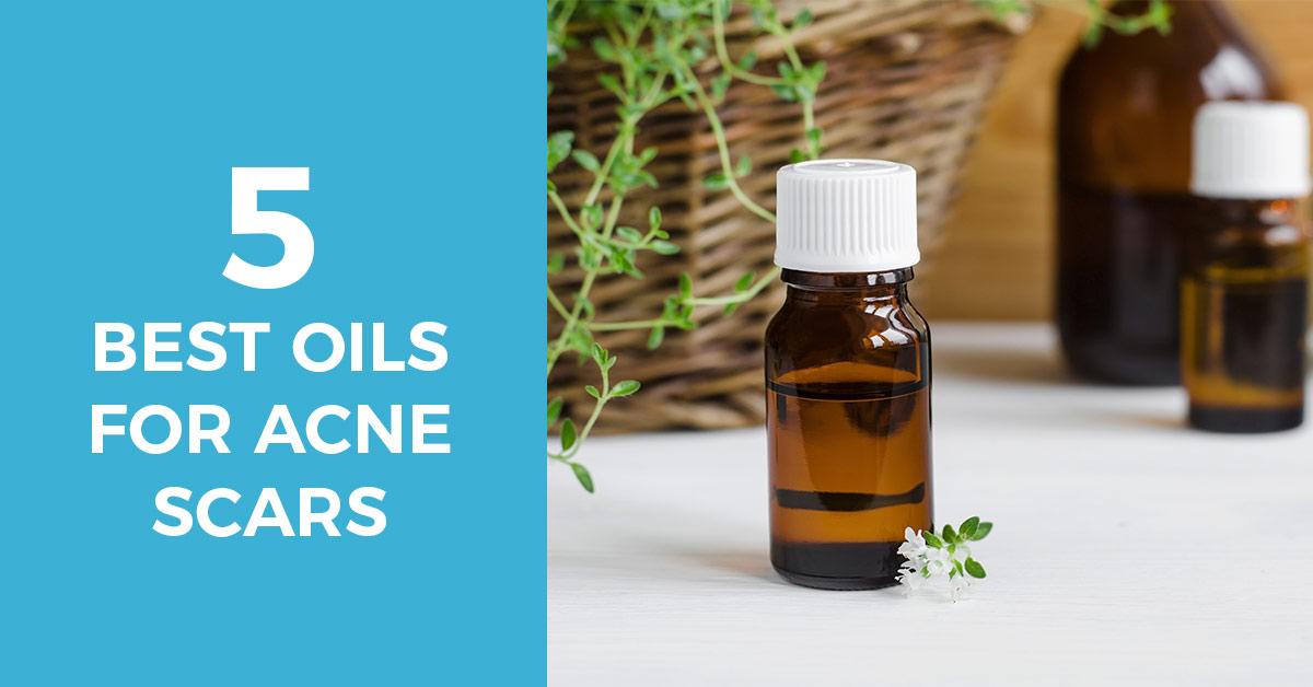 5 Best Oils For Acne Scars: Vanquish Acne Scars Forever