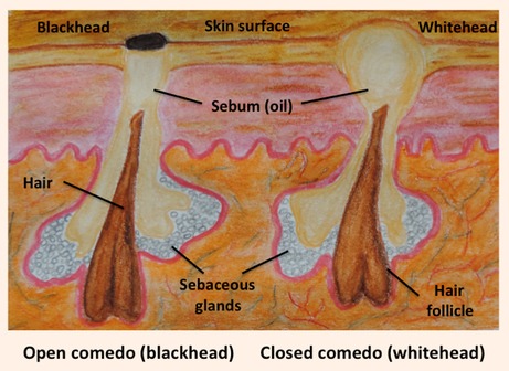 How are blackheads and whiteheads formed