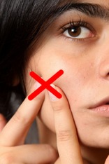 Squeezing is the main cause of acne scars.