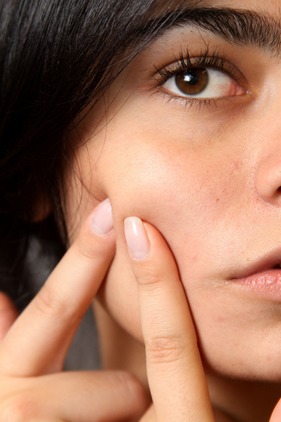 Acne scars are created by squeezing