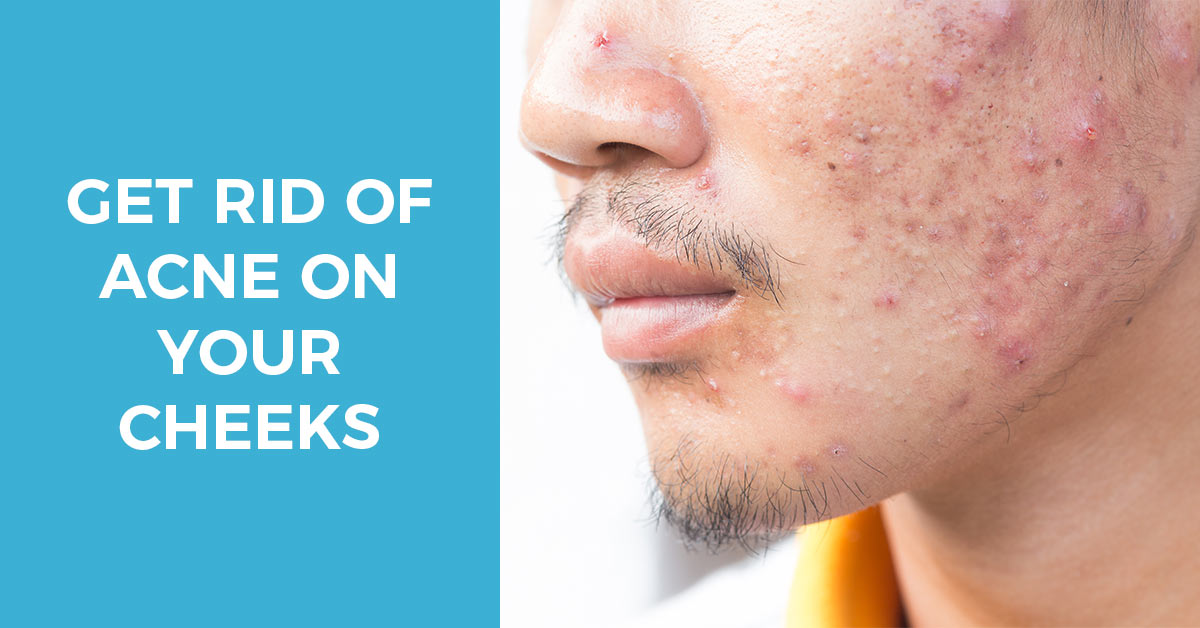 effectively treat acne on cheeks naturally or with products