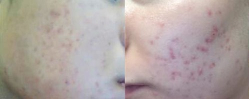 Hyperpigmentation