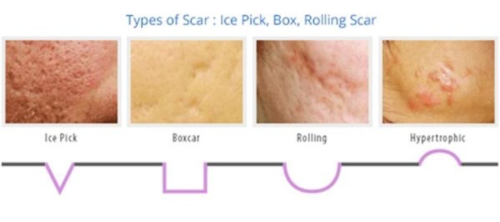 Which scars will micro needling help you with