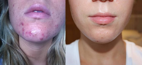 Acne treatment before and after