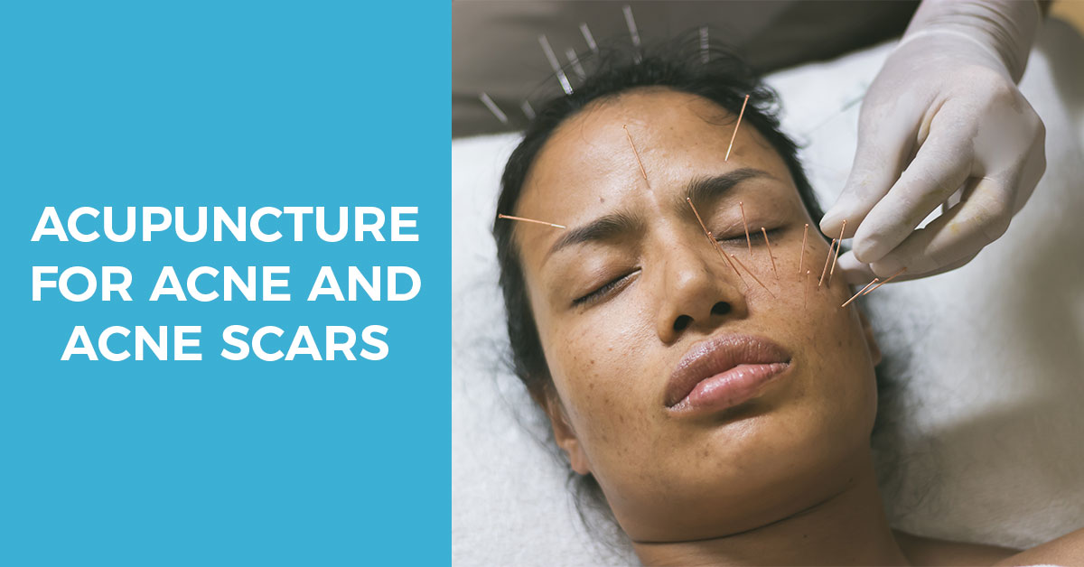 acupuncture for acne and acne scar treatment