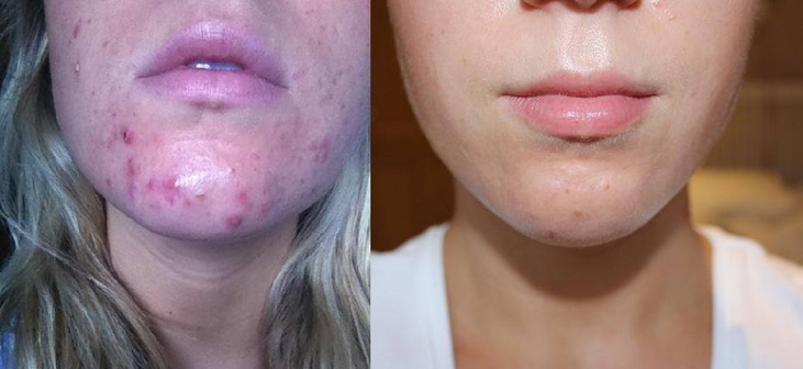 Acupuncture acne before and after