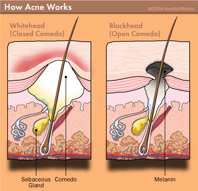 which are comedogenic products