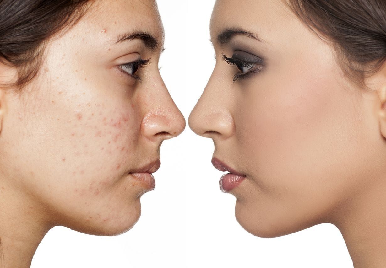 Tretinoin for Acne on Face