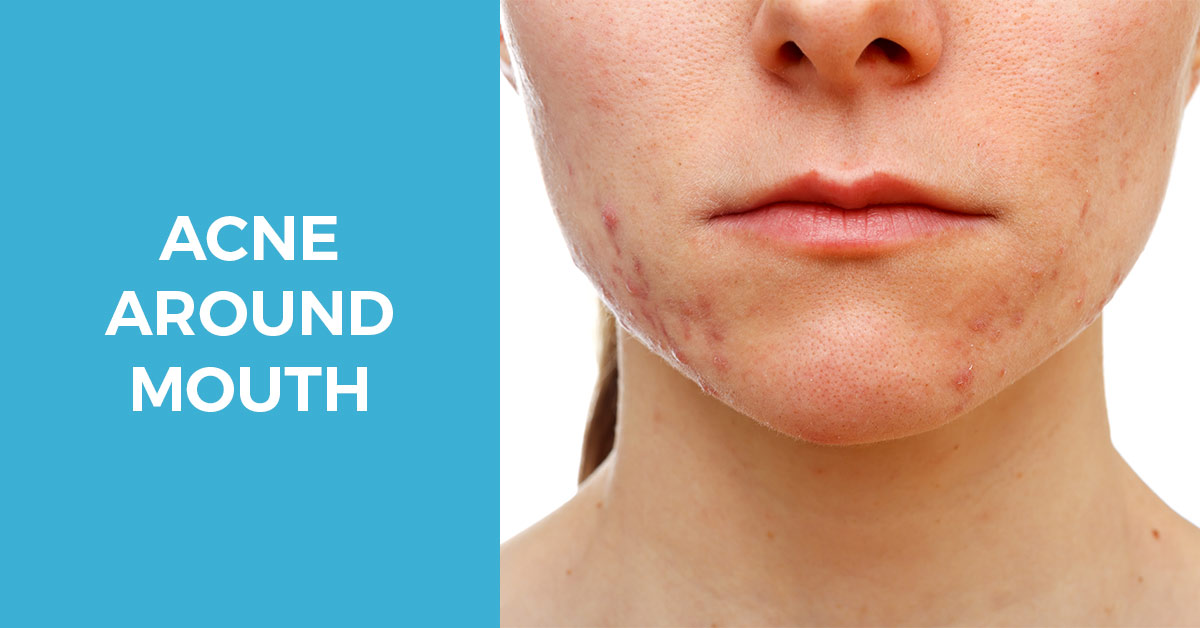 Why you have Acne Around the Mouth and how to get rid of it