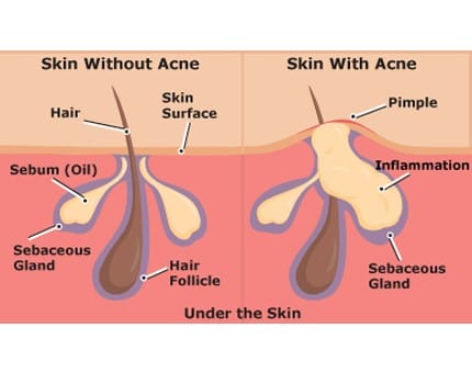 Skin with and without acne around mouth