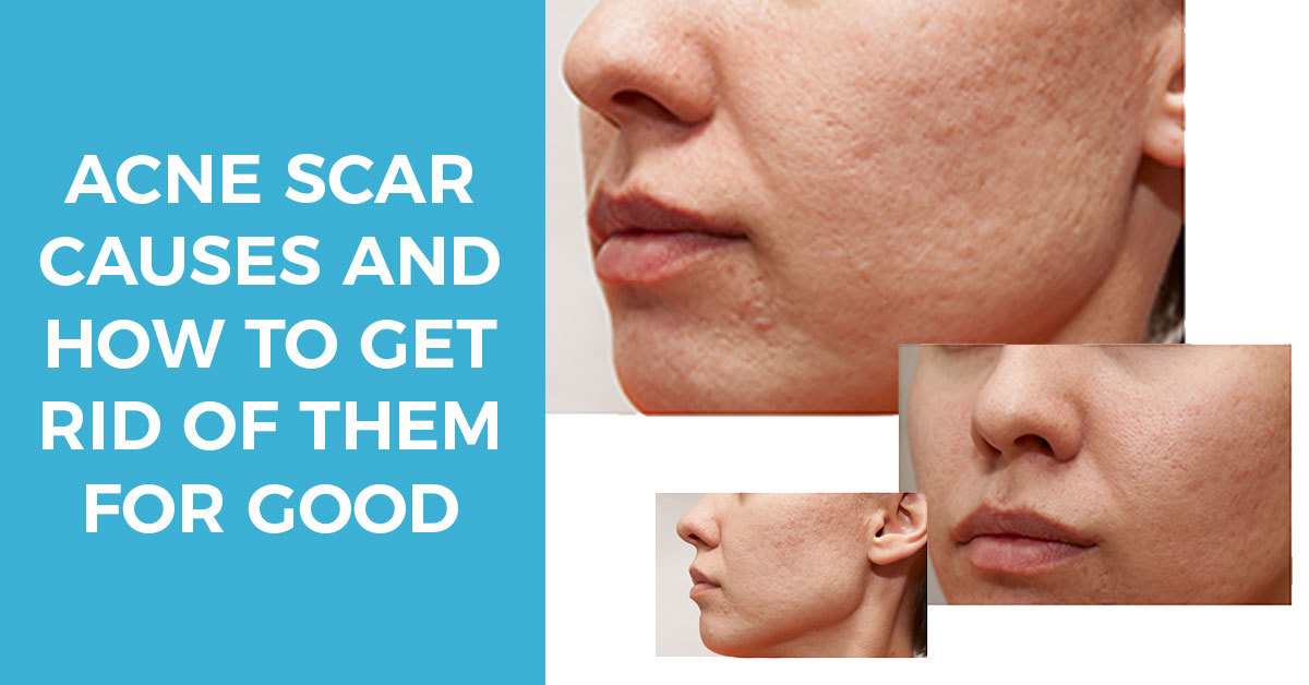 6 Ways to Prevent Acne Scars and Effectively Treat Them