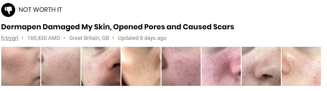 dermapen-for-acne-scars-before-after-fail