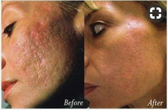 dermapen-for-acne-scars-before-after-photo