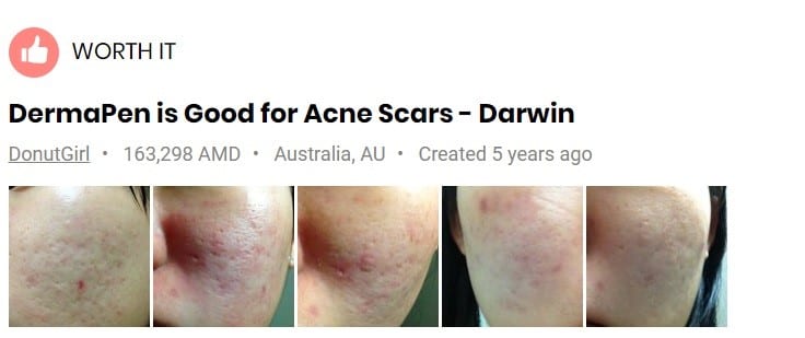 dermapen-for-acne-scars-before-after-photos