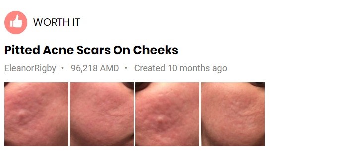 dermapen-for-acne-scars-before-after