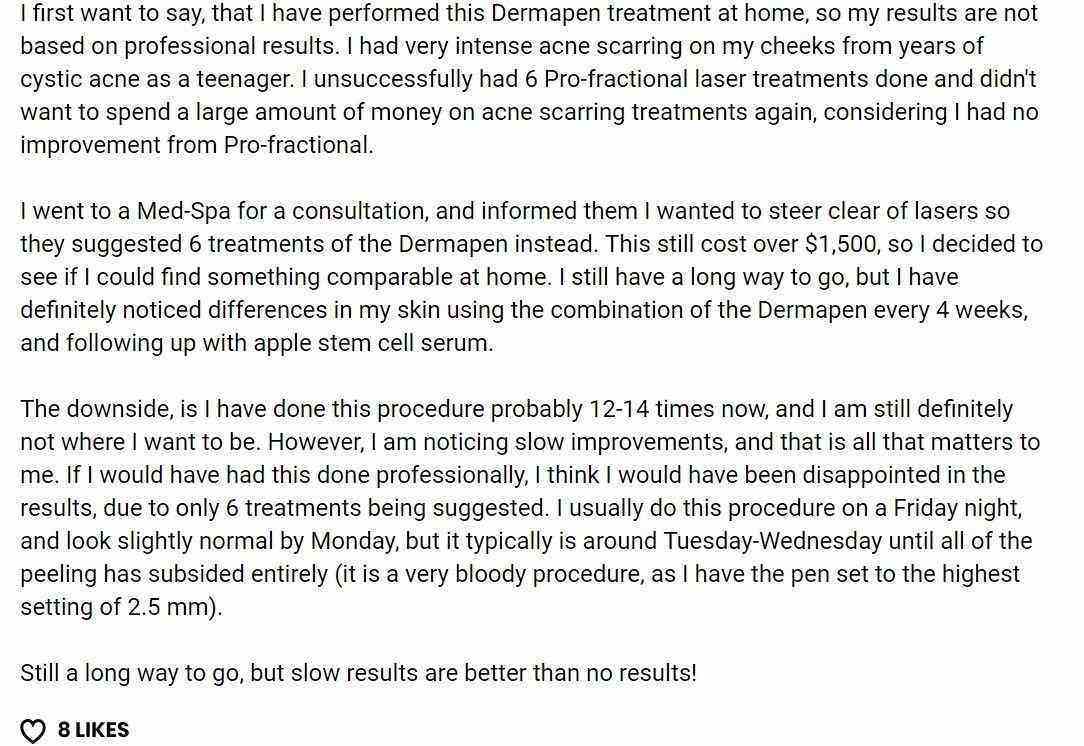 dermapen-for-acne-scars-review-1