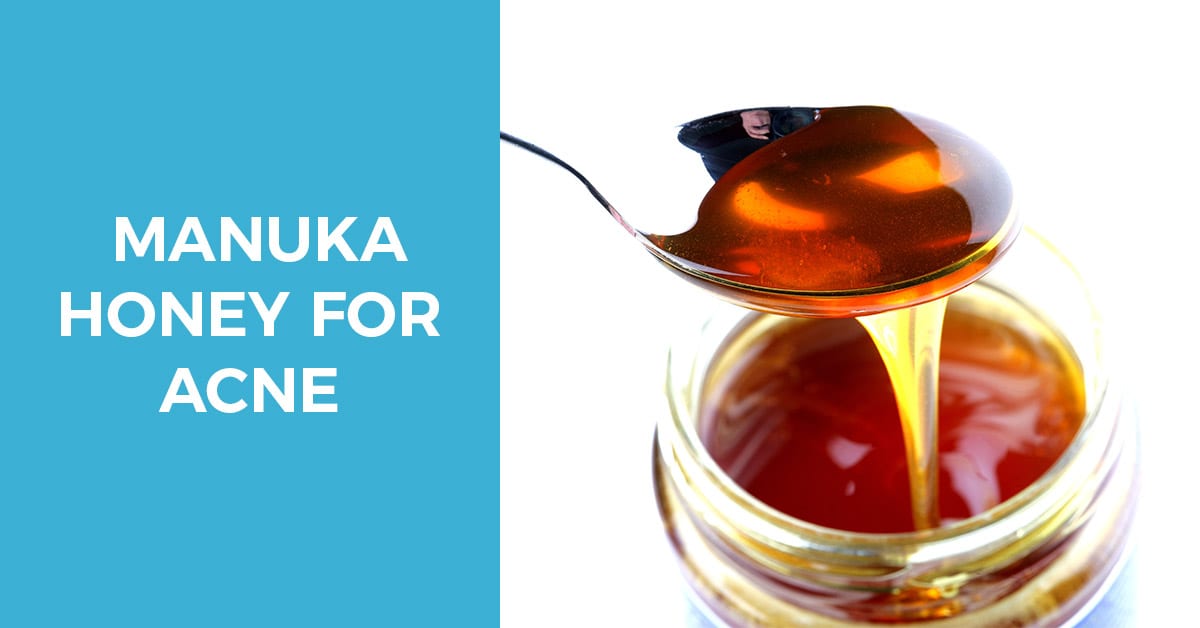 Manuka Honey for Acne – How it Works and What to Expect