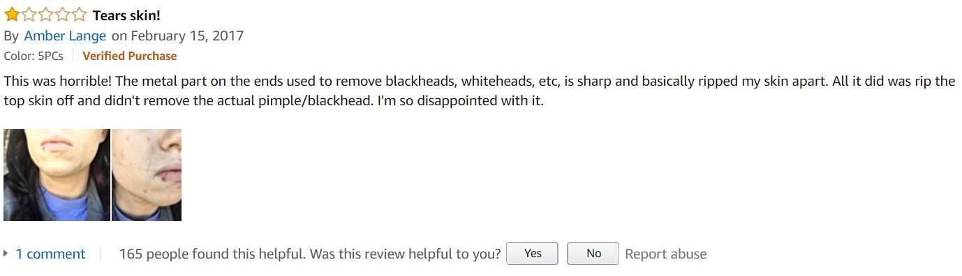 BESTOPE-Blackhead-Remover-customer-review-4