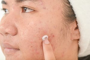 mupirocin-vs-neosporin-for-acne