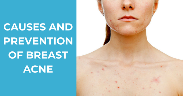 How to Prevent and Treat Breast Acne Effectively