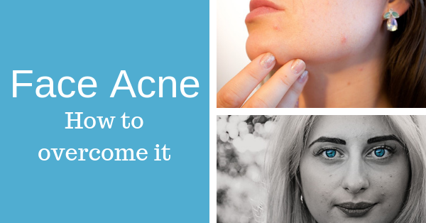 Face Acne – Facial Acne Prevention and Treatment